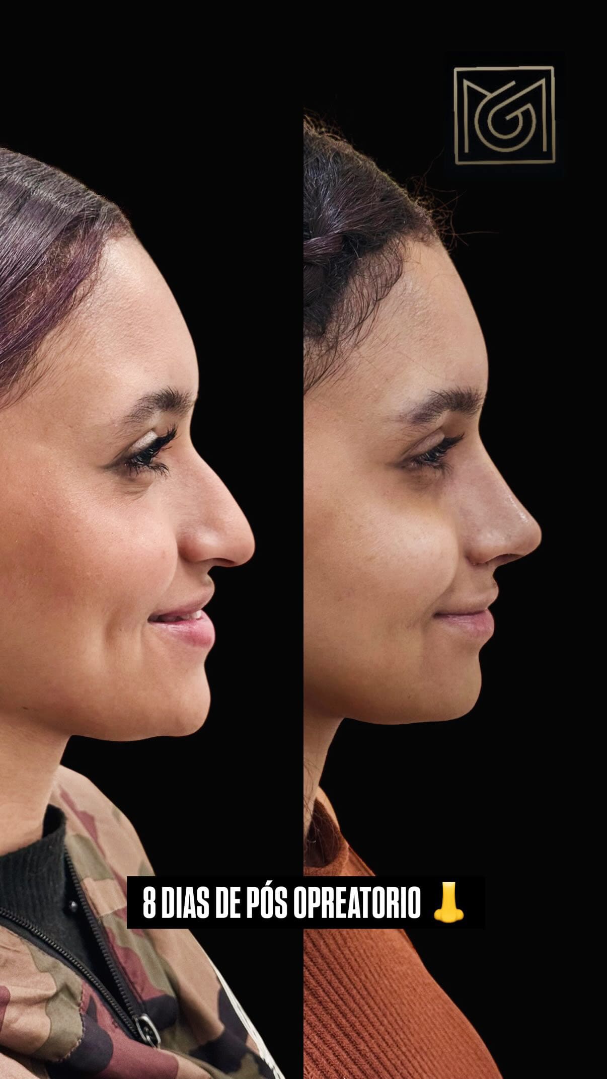 Paciente satisfeita pós-rinoplastia